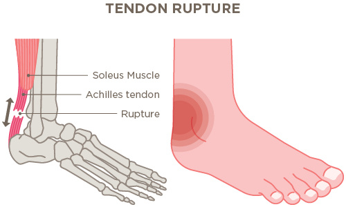 Sprained achilles heel store